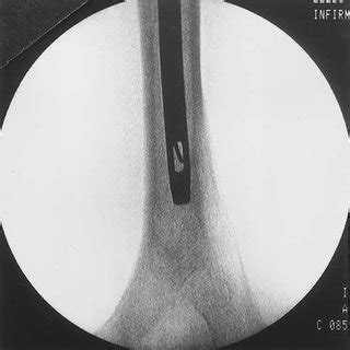 Fluoroscopic Confirmation Of Correct Guide Wire Placement In