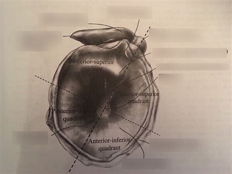 Tympanic Membrane Perforation Flashcards Quizlet Hot Sex Picture