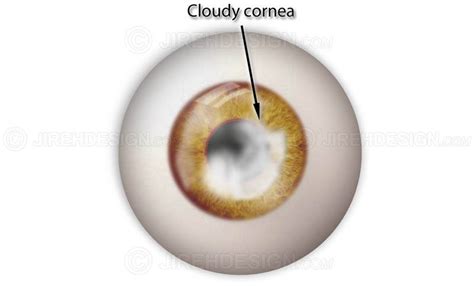 Corneal Clouding