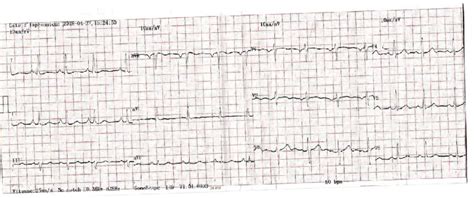 ECG after fibrinolysis showing a return to isoelectric line of ST ...