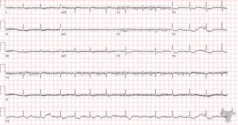 Digoxin Toxicity Ecg Stampede