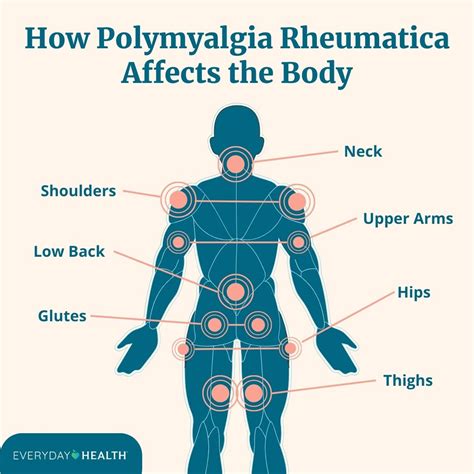 What Is Polymyalgia Rheumatica Symptoms Causes Diagnosis And Treatment