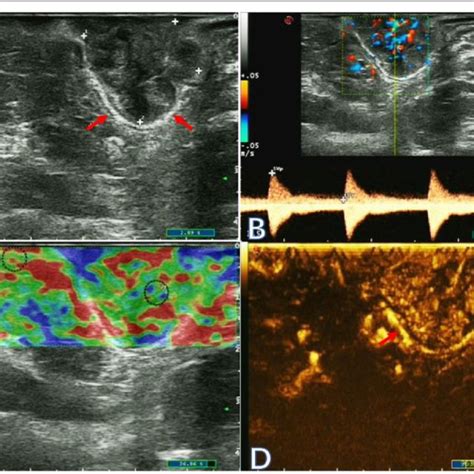 Two Dimensional Ultrasonogram A Color Flow And Pulsed Doppler Image