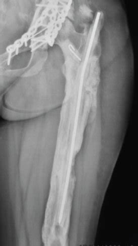 X-ray after the femoral shaft fracture (a), after internal fixation of... | Download Scientific ...