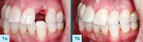 When to Choose Screw-Retained Over Cement-Retained Crowns