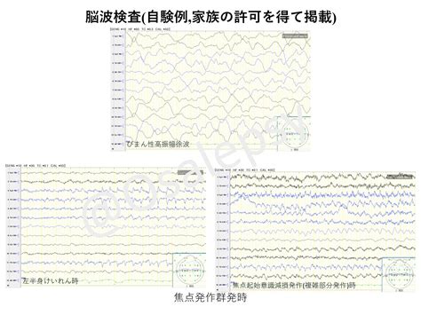 Osalepsy＠小児科・てんかん専門医 On Twitter 脳波では意識障害のある際には 図の上のような大きなゆっくりな波高振幅徐波
