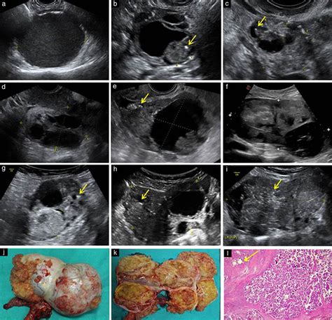 Imaging In Gynecological Disease 12 Clinical And Ultrasound Features Of Invasive And Non