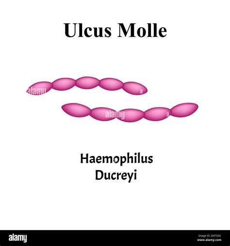 Ulcus Molle Haemophilus Ducreyi Infecciones Bacterianas Enfermedades