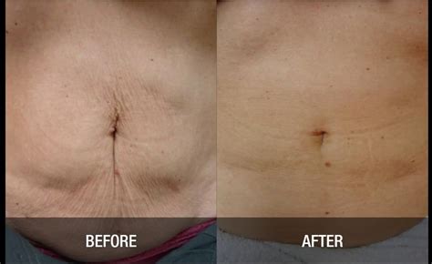 Velashape Before And After Abdomen