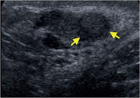 Epididymis Lump Ultrasound