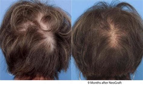 Female Hair Restoration Before & After Photos | Dr. Guy Cappuccino