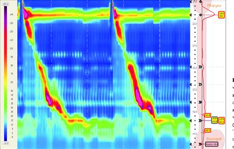 Figure 1 From Clinical Application Of Esophageal High Resolution