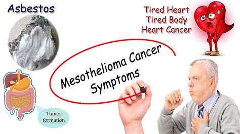 Mesothelioma cancer symptoms | moonlightforall.com