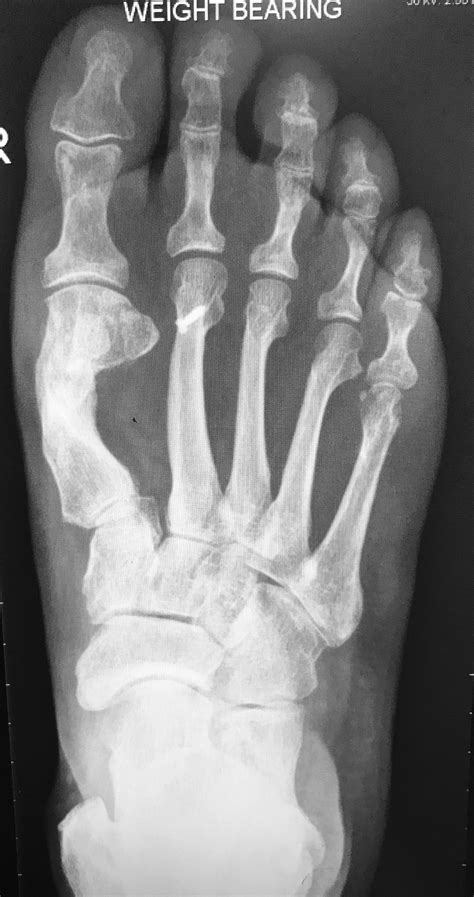 Bunion X Ray Before After