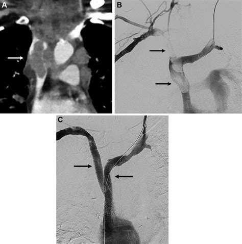 Kissing Viabahn VBX Stent Graft Reconstruction Of Thoracic Central