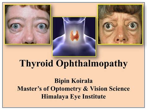 Real Thyroid Ophthalmopathypptx