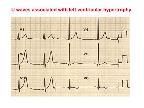 U Waves Ecg 8
