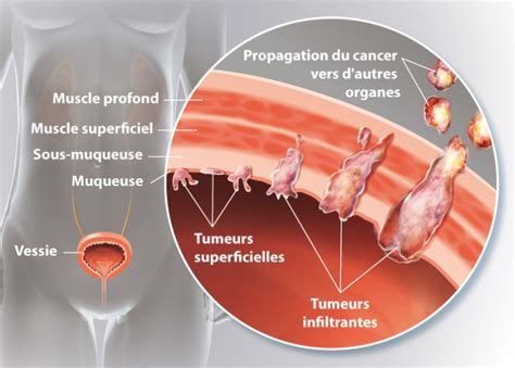 Les tumeurs de vessie expliquées par le Docteur Adjiman