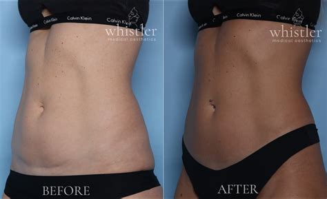 Coolsculpting Before And After Photos Incredible Outcomes