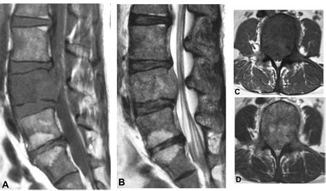 An Intraosseous Malignant Peripheral Nerve Sheath Tumor Of The Lumbar