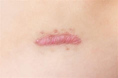 Keloid Scar - Katu Dermatology Clinic