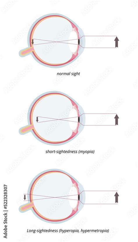 Myopia And Hyperopia Three Common Eye Conditions Normal Sight Short