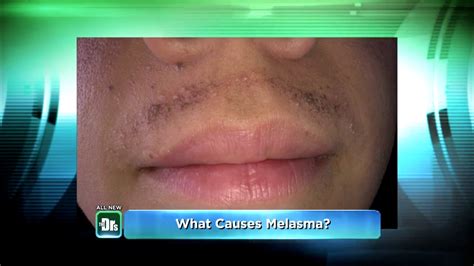 Makeup To Cover Melasma On Upper Lip - Mugeek Vidalondon