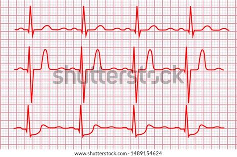 Cardiogram Pulse Line On Pink Grid Stock Vector Royalty Free