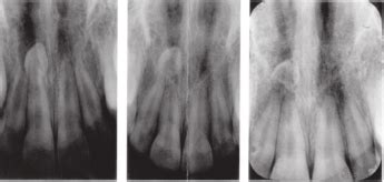 Case Showing Gradual Resorption Of Mesiodens From 9 Years And 9 Months