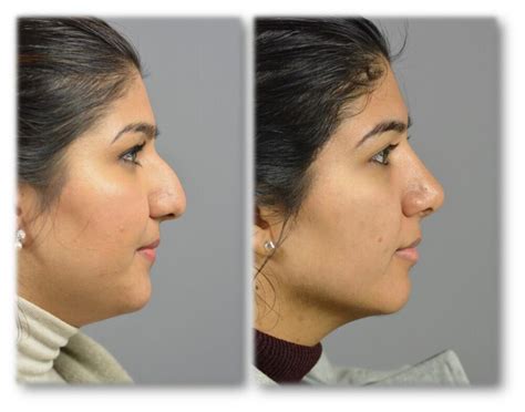 Nose Surgery Before After Patient 22 Dr Marotta