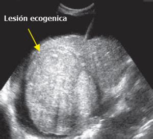 Ultrasonido Lesiones Focales Del H Gado Gastro M Rida