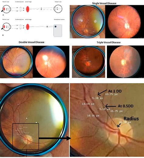 The Upper Panel Shows Principles Of Fundus Photography With A