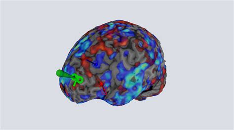 Using Brain Scans To Personalize The Treatment Of Depression Advanced