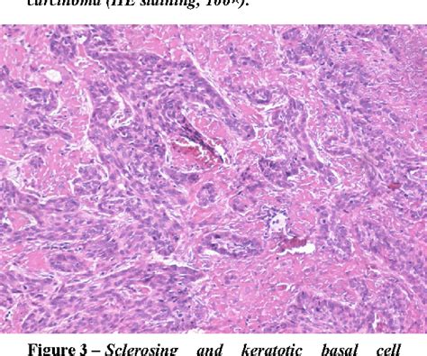 Figure From Immunohistochemical Nuclear Staining For P Pcna Ki