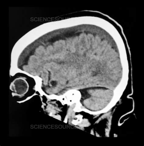 Photograph Subacute Subdural Hematoma On Ct Science Source Images