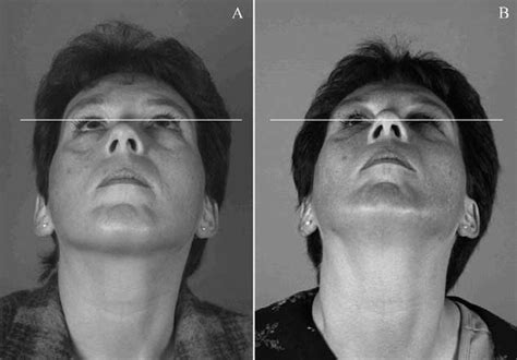 Pre A And Postoperative B Photos Of Patient 2 Are Shown For