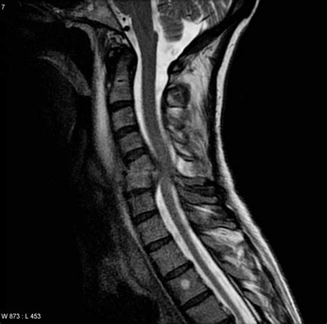 Osteomyelitis Mri Spine