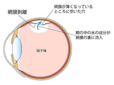 網膜剥離の手術硝子体手術網膜復位術茨城県水戸市の小沢眼科内科病院