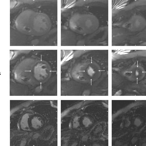 Example Of A Case Of Semi Quantitative Myocardial Perfusion By