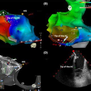 Electroanatomical Reconstruction Of The Right Atrium With Ablation