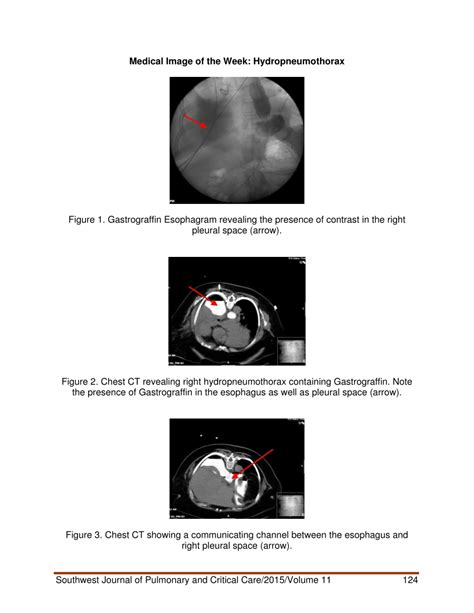 PDF Medical Image Of The Week Hydropneumothorax