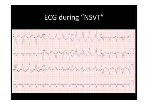 Pacemaker Mediated Tachycardia Or Not Ppt