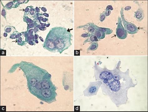 Renal Tubular Cells Urine