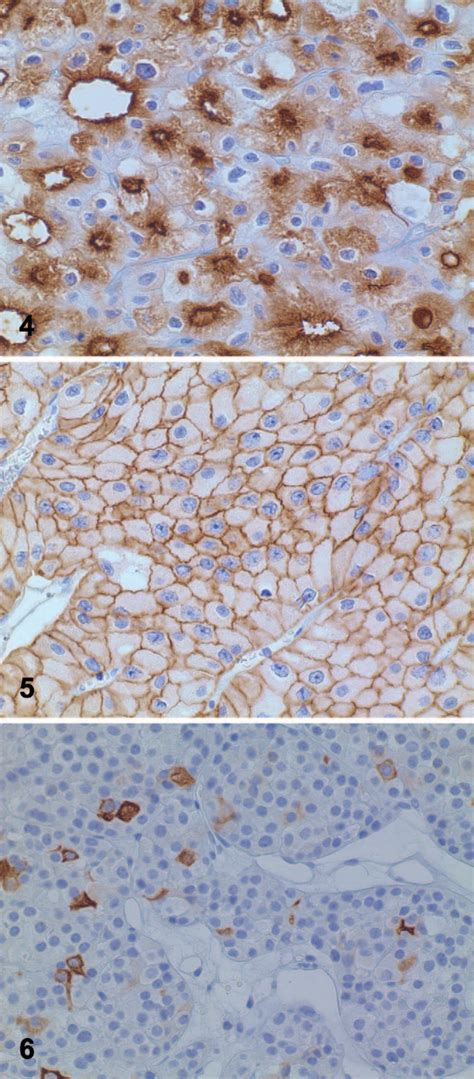 Figure 1 From Immunohistochemical Analysis Of Chromophobe Renal Cell