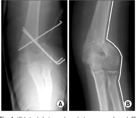 Figure 1 From Lateral Closing Wedge Supracondylar Osteotomy Of The