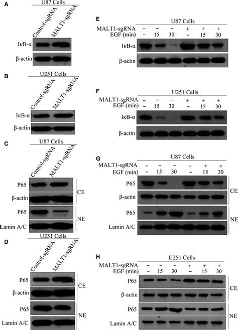 Knocking out MALT1 inhibits EGFRinduced NFκB activation in GBM cells