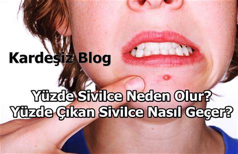 Y Zde Sivilce Neden Olur Y Zde Kan Sivilce Nas L Ge Er