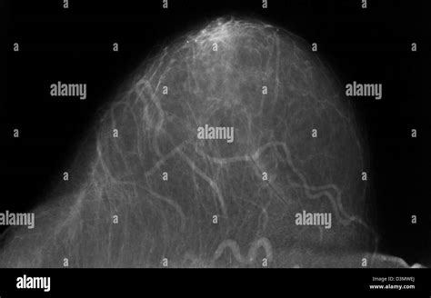 Mammogram Shown Benign Calcifications Stock Photo Alamy