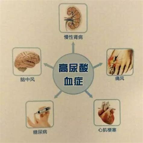 痛风痛起来真要命！痛风的危害有多大？看完你就明白了尿酸