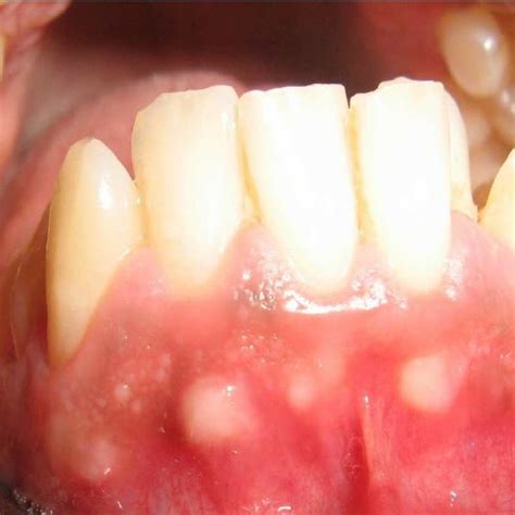 Case Showing Two Gfns On The Maxillary Anterior Muco Gingival